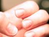 Заболевания ногтей и их симптомы